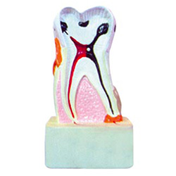 LM1109 牙体病理模型